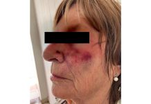 Brutal robo en Mar del Plata: destrozaron la dentadura de una jubilada de un golpe y atropellaron a su hija