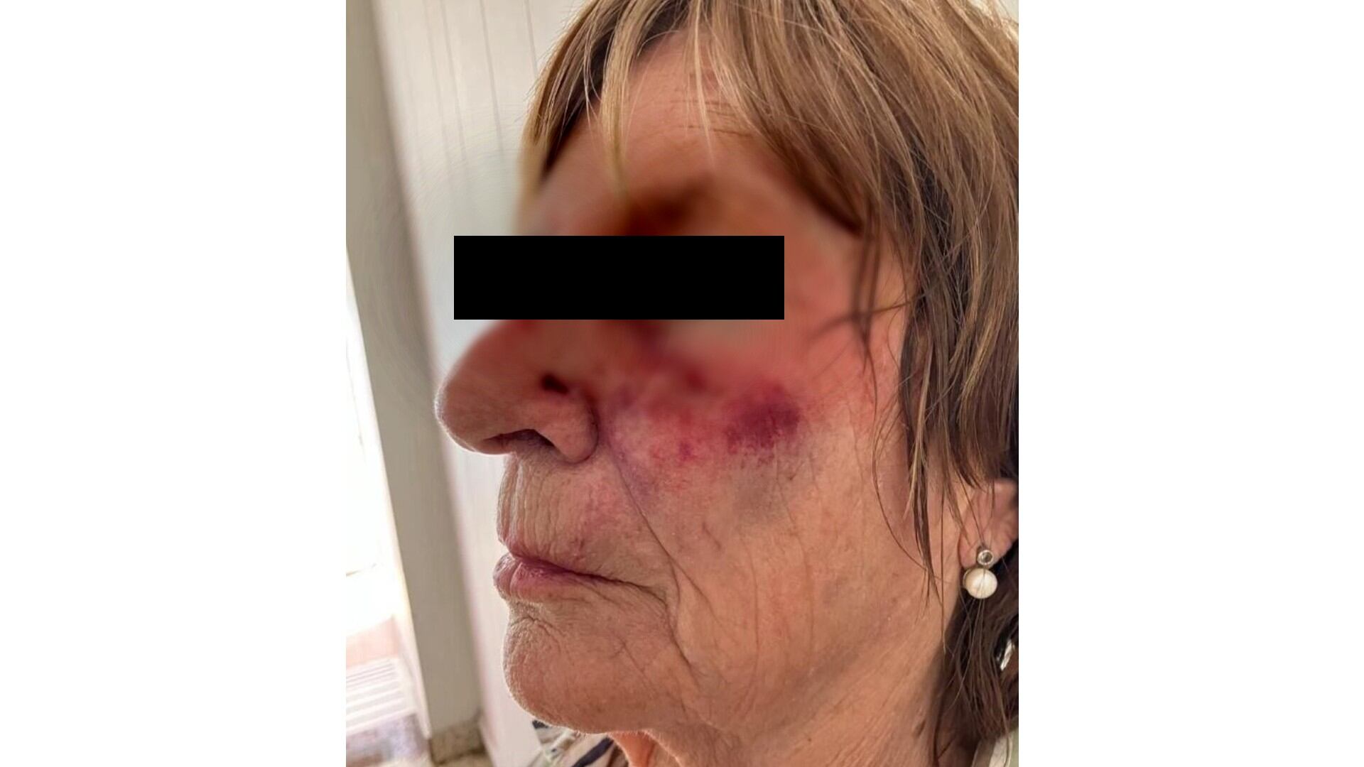 Brutal robo en Mar del Plata: destrozaron la dentadura de una jubilada de un golpe y atropellaron a su hija