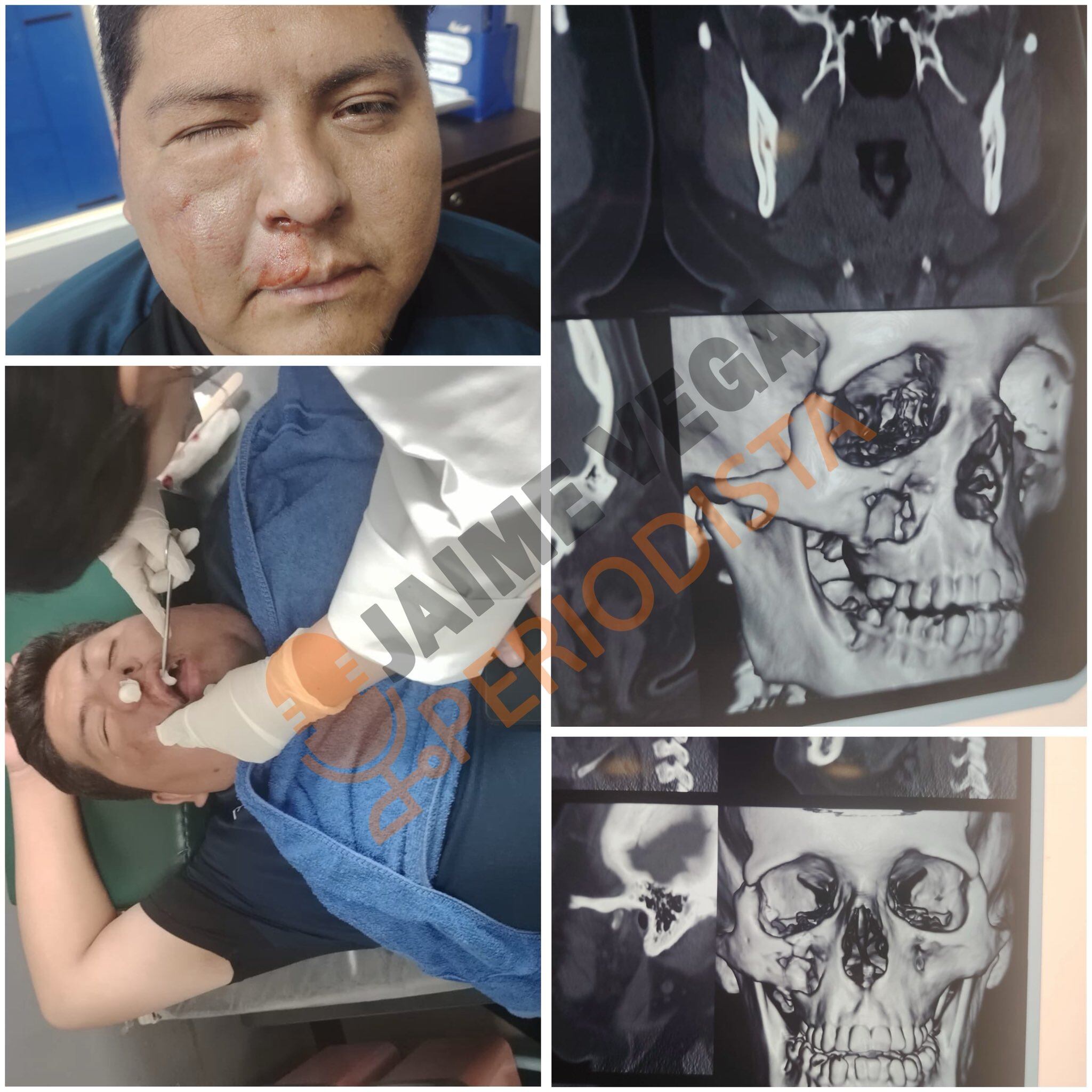 Un fracturado, gases, balas de goma y un DT argentino entre los 17 expulsados: el video de la batalla campal en Bolivia