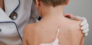 Activaron un protocolo de vigilancia en La Plata por un contacto estrecho con los turistas con sarampión